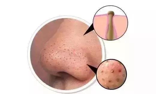 说黑头该死的朋友，没准儿是你自己太懒呢