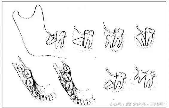 又肿又痛不会白怎么处理,又肿又痛可以去拔牙吗