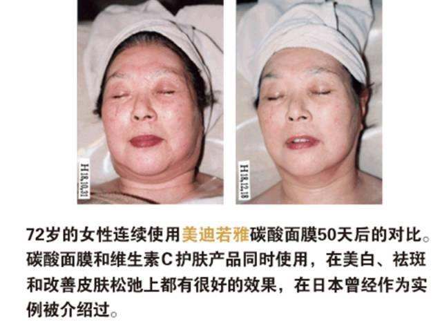 贵妇面膜淡化细纹,韩国贵妇面膜胶原蛋白很干