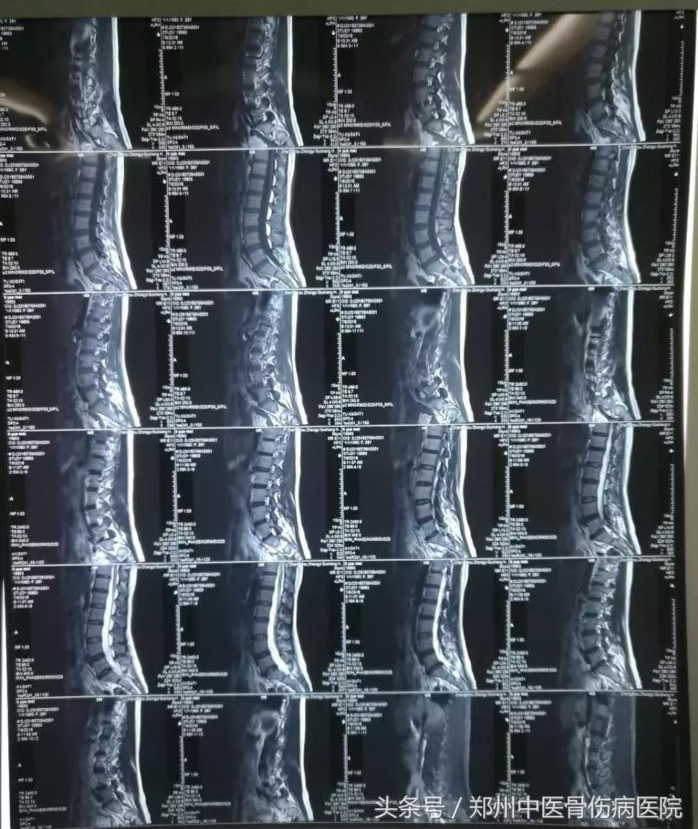 低温射频消融术治腰椎间盘突出,低温等离子消融术治疗腰间盘突出