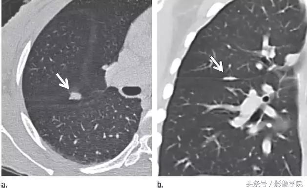 肺结节14种影像,一百例有结果的肺结节影像分析