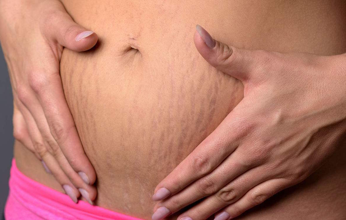 怀孕七个月长妊娠纹了怎么办,怀孕七个月长了妊娠纹怎么办