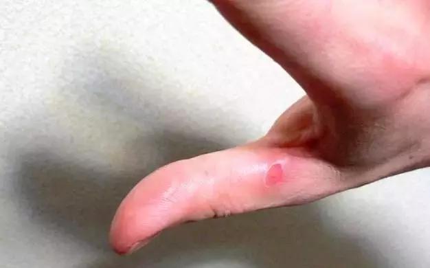 在家身上被开水烫伤后怎么急救,儿童开水烫伤急救处理