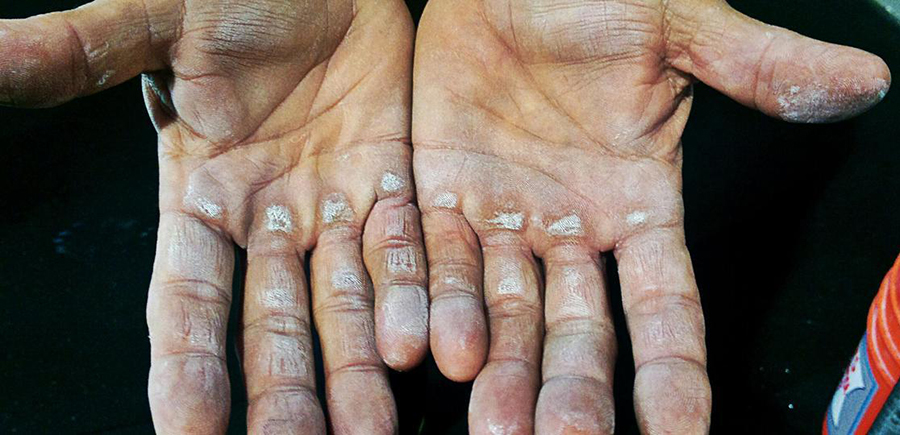 手上长老茧是身体缺什么吗,长时间健身手上有老茧怎么去除