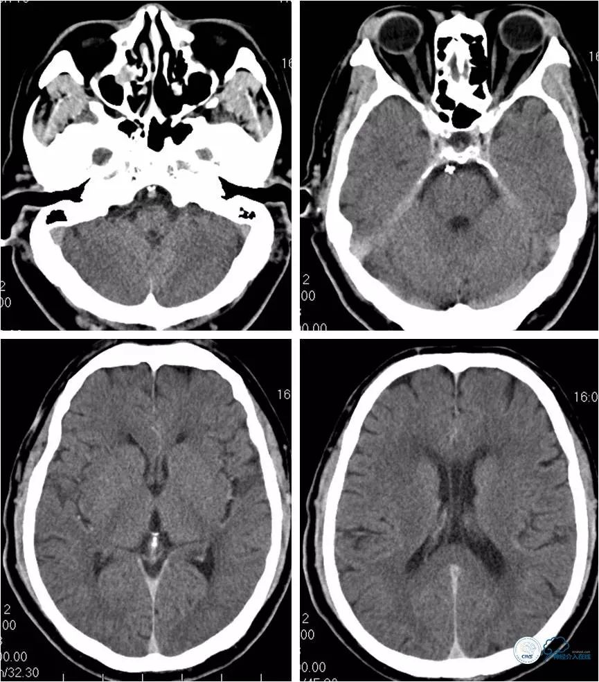 天坛周记｜左椎动脉开口及基底动脉串联狭窄血管内介入治疗1例
