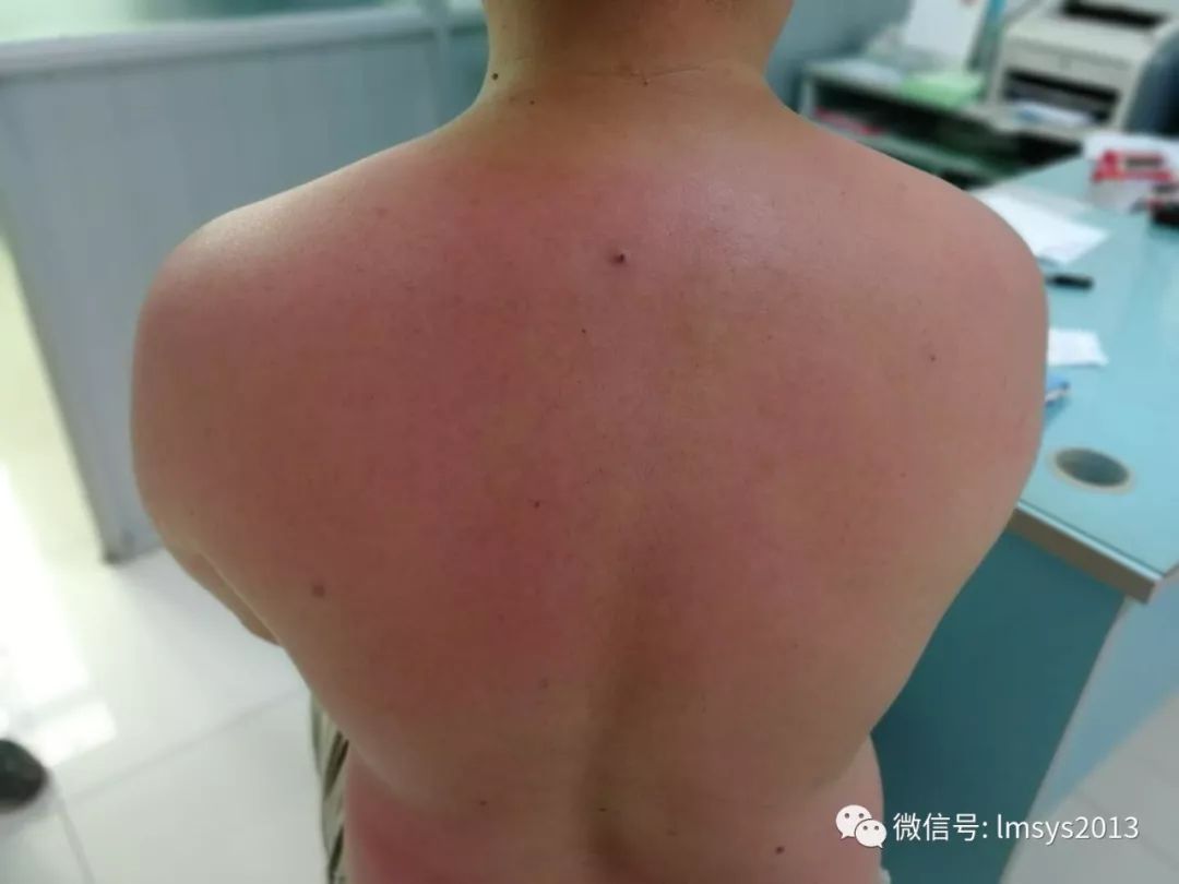 夏日旅游防晒必备推荐,暑假旅游防晒必备物品有哪些