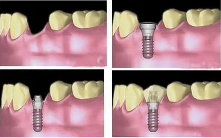 为什么牙科种植牙那么贵,为什么口腔医院都推荐种植牙