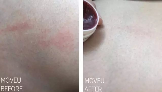 “万用”紫草膏，解决了你多少皮肤烦恼？