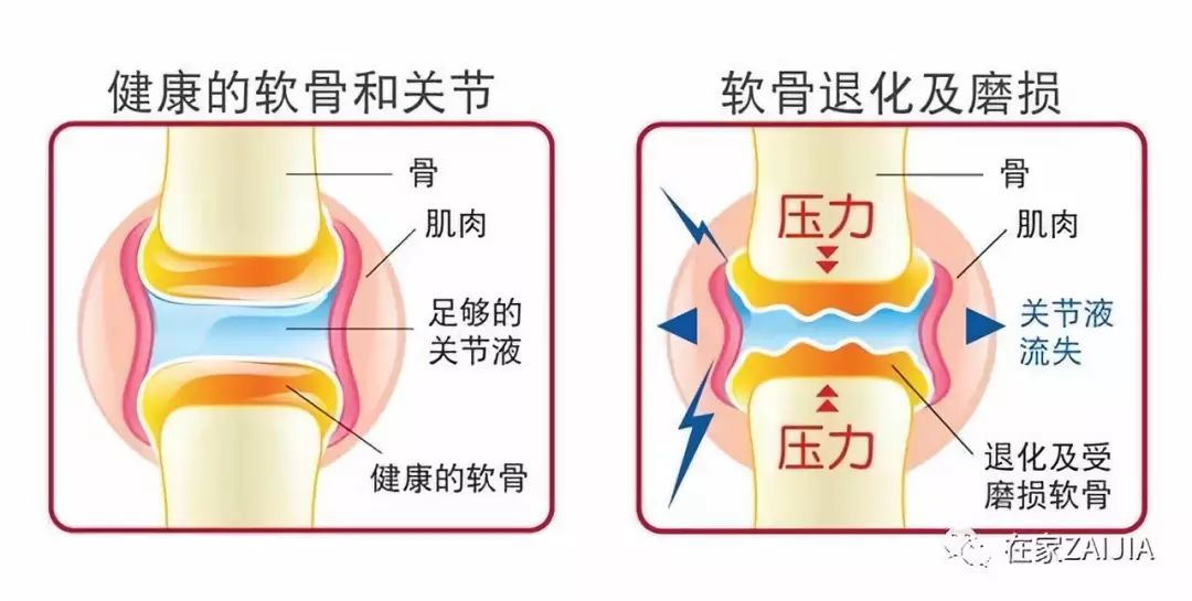 关节疼痛最快的外用偏方,快速缓解关节疼痛的凝胶