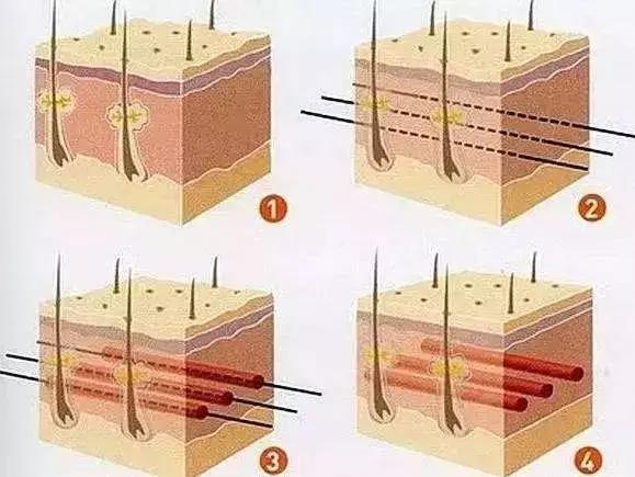 埋蛋白线有什么用,脸上埋蛋白小线真的紧致吗