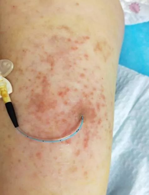 picc皮疹处理,picc湿疹的护理措施