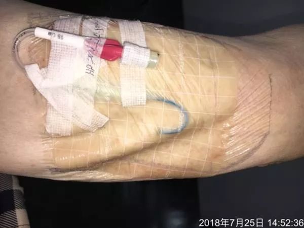 picc皮疹处理,picc湿疹的护理措施