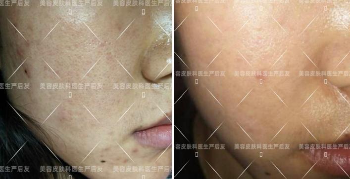 治疗毛孔粗大的护肤品,烟酰胺可以治疗毛孔粗大吗