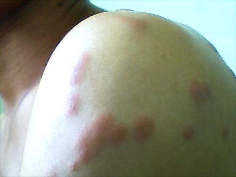 十种可怕吸血虫,世界上最致命的吸血虫子