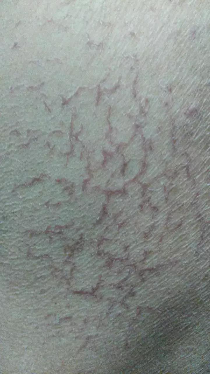 化疗后烂手烂脚怎么办,化疗手脚皮肤溃烂如何处理