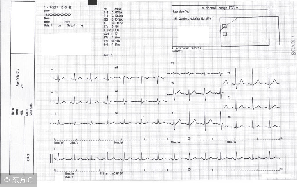 什么是早搏有什么后果,什么叫早搏有什么危害