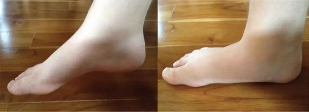 儿童轻微扁平足还需要穿矫正鞋吗,儿童扁平足x型腿如何矫正