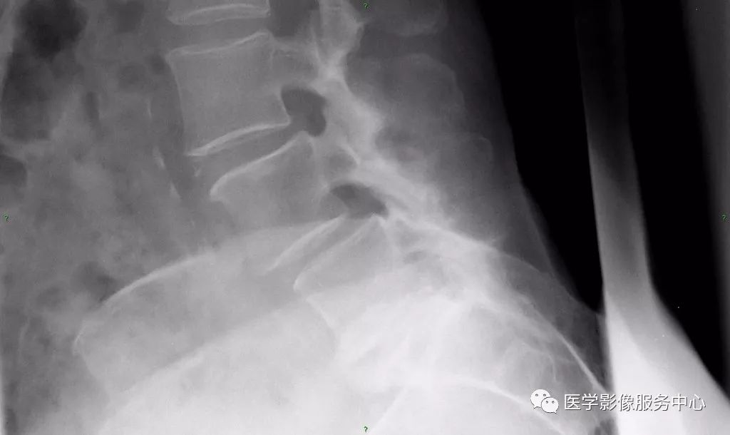 腰痛患者常用的特殊检查方法,腰痛影像诊断