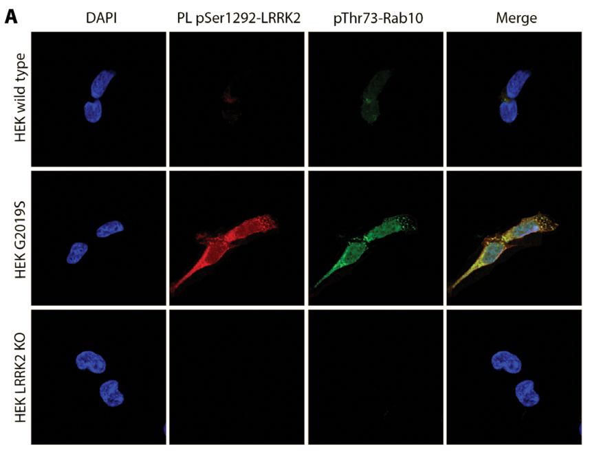 《科学》子刊：科学家首次证实正常的LRRK2基因也会促进帕金森病，90%发病原因不明的患者或许也有救了｜科学大发现