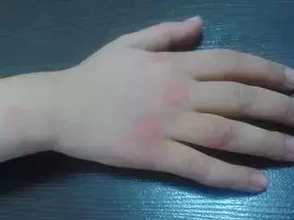 六个月宝宝湿疹皮肤破溃,宝宝起红疹破皮水泡