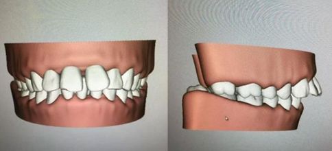 速看！刚刚发布大消息！8月起牙齿矫正、种植牙这10项费用全免！