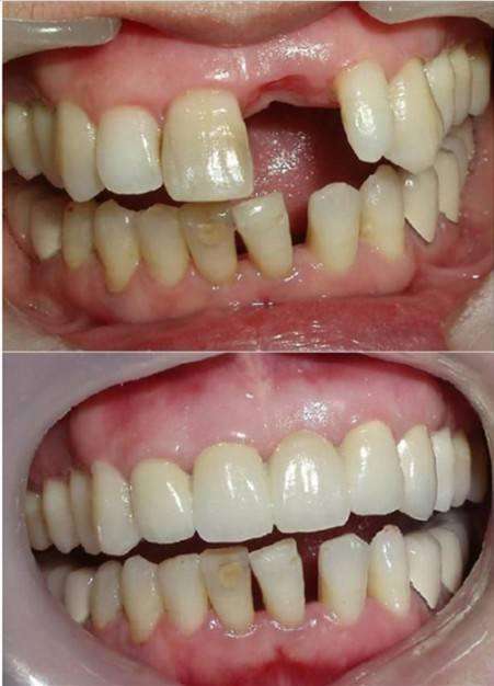 镶牙和种牙的区别种植牙的危害,种植牙的利与弊能镶牙就不要种牙