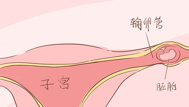 宫外孕没用药自动下降是什么原因,宫外孕在卵巢旁边什么原因