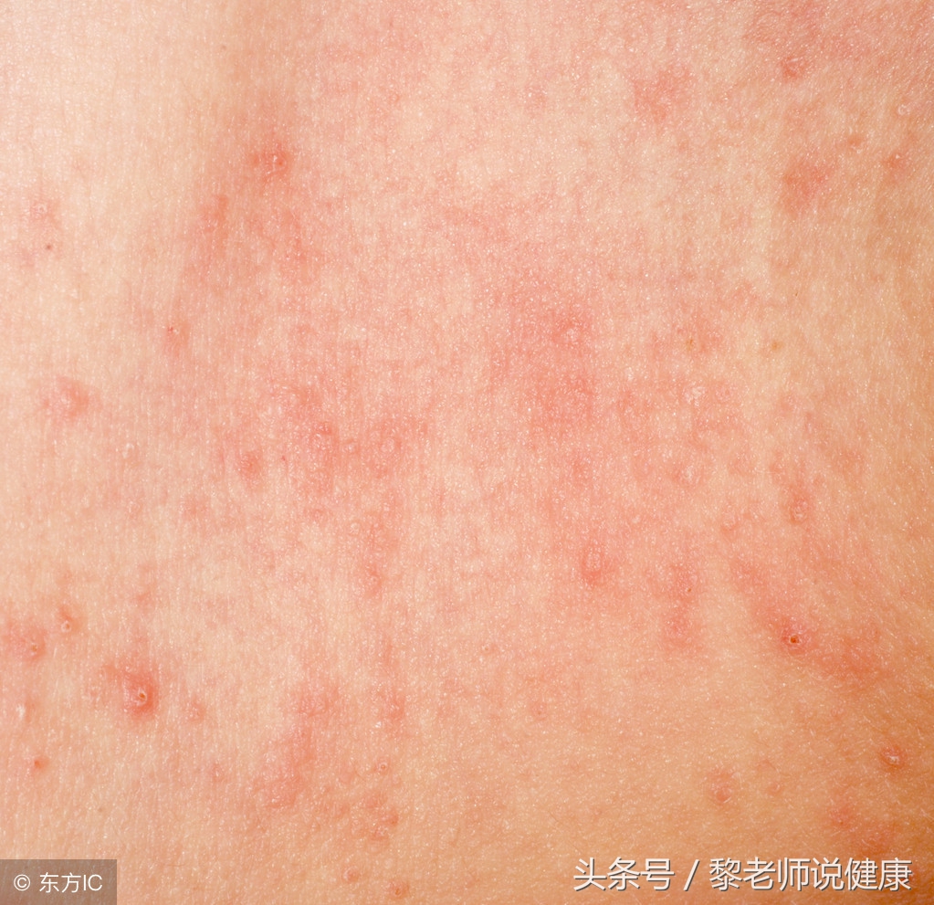 湿疹急性期皮肤溃烂好痒怎么止痒,湿疹溃烂可用哈西奈德溶液吗