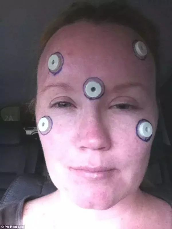 感染食脑虫的人,感染食脑虫的动物