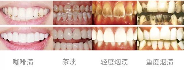 小月龄刷牙齿怎么刷得干净,刷一次牙就能让牙齿变白