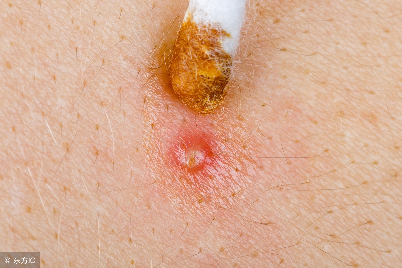 皮肤毛囊炎症状及治疗方法,胸口毛囊炎发红发痒