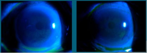 角膜上皮细胞损伤多久能恢复,治疗角膜上皮细胞损伤全国专家