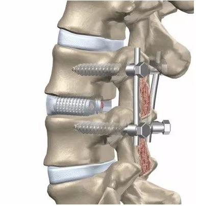 脊柱打6个钢钉手术需要多长时间,脊椎打钉子取出要做手术吗