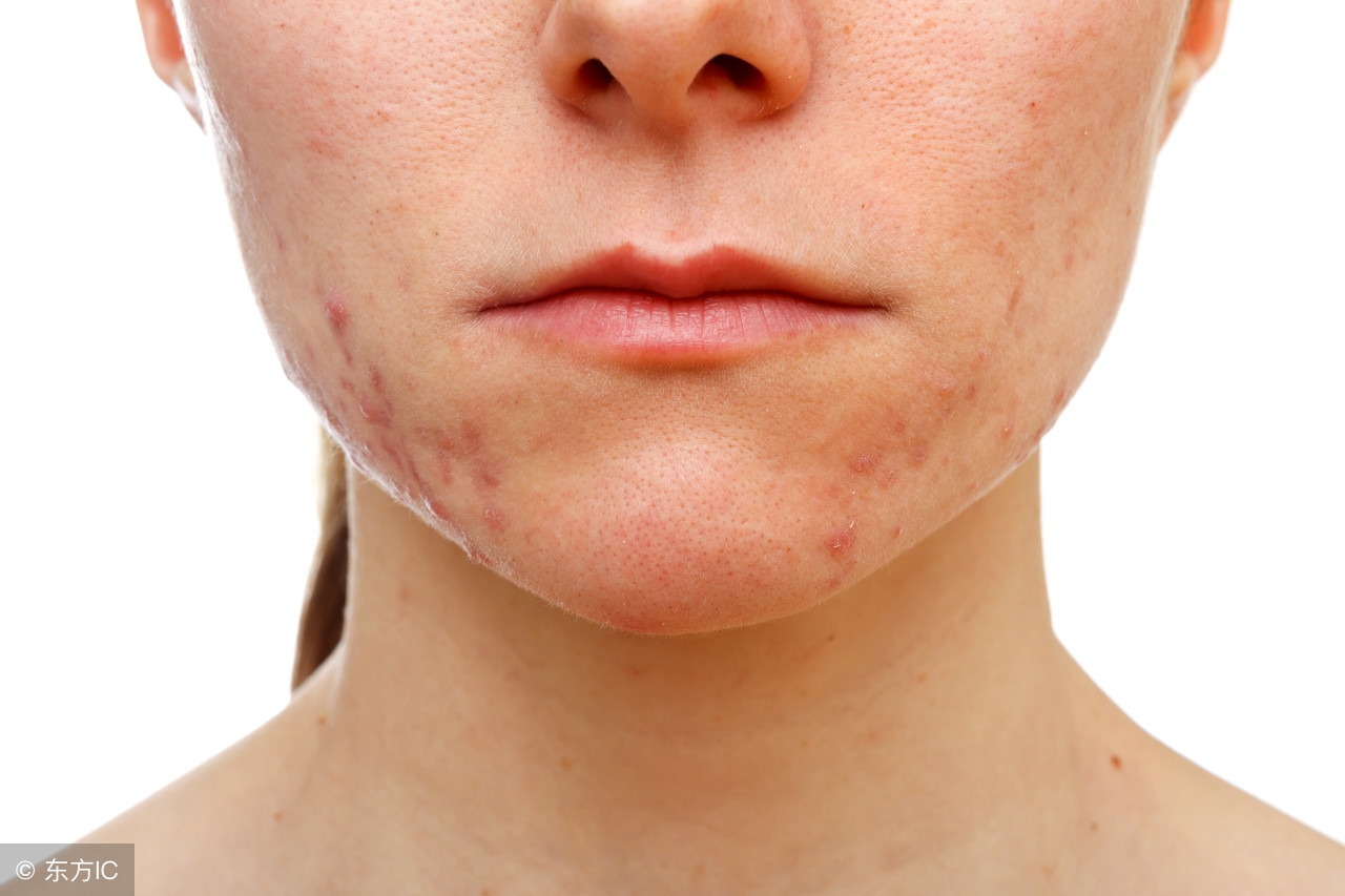 女孩子脸上有痘印怎么去掉,40岁脸上长痘印怎么去掉