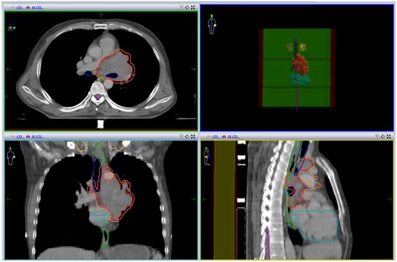 安罗替尼治小细胞肺癌吗,卡瑞利珠能治小细胞肺癌吗