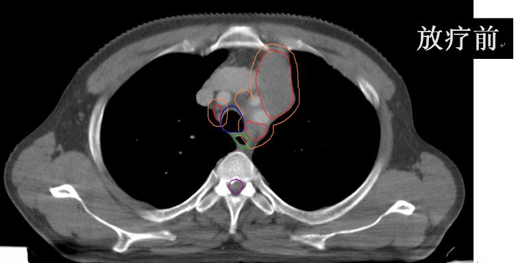 安罗替尼治小细胞肺癌吗,卡瑞利珠能治小细胞肺癌吗