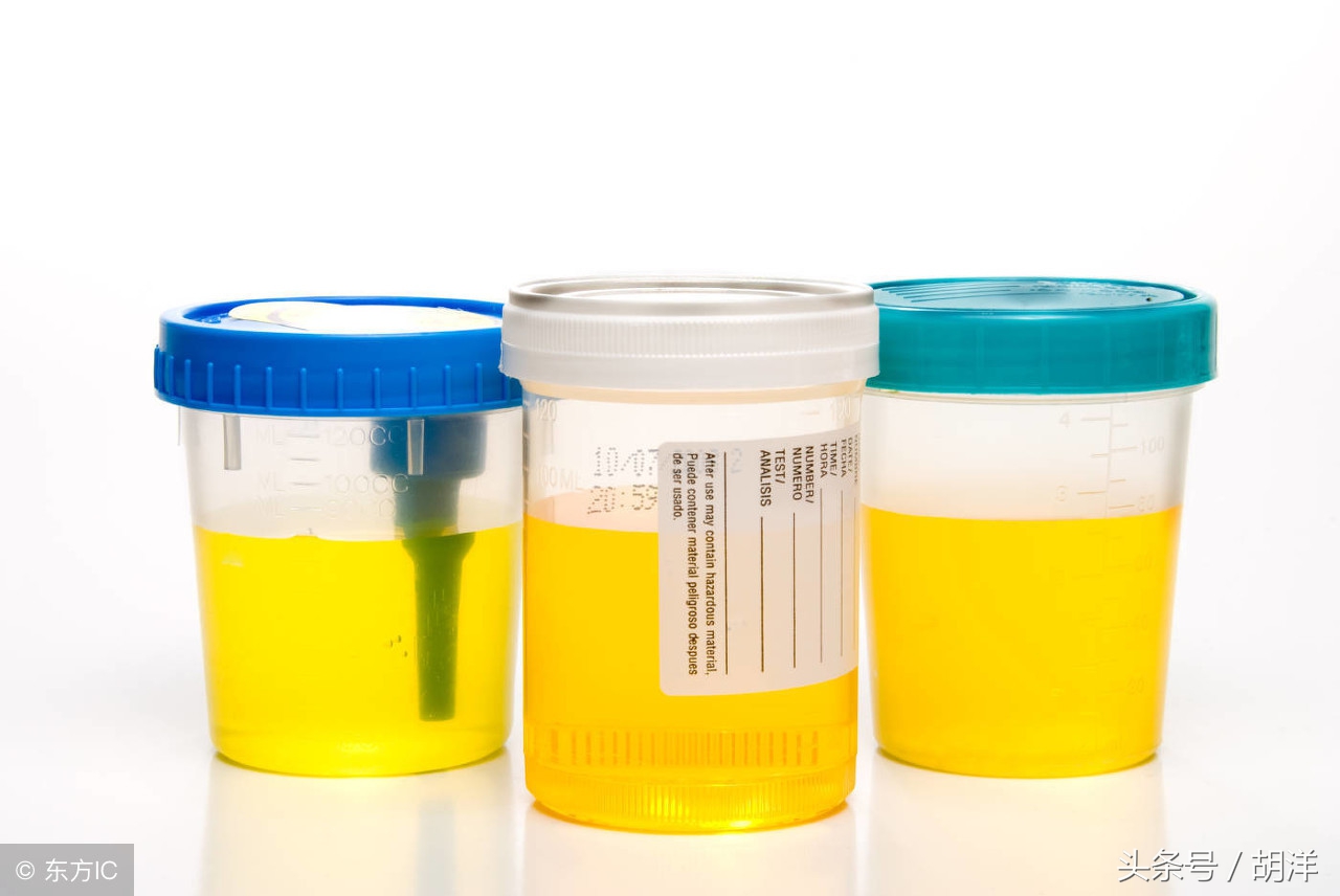 尿中有白细胞怎么治,尿里有白细胞是怎么回事尿路感染