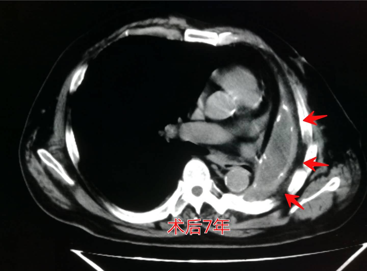 年轻人切除一个肾脏,切除一个肾脏手术全过程