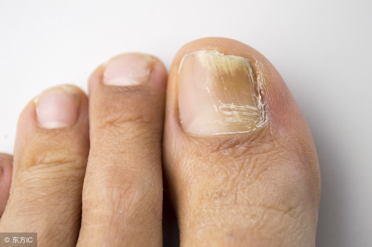 灰指甲怎么看,得了灰指甲怎么办这个方法告诉你