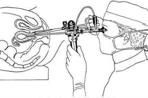 妇科专家讲解视频大全,妇科宫腔镜是怎么检查的