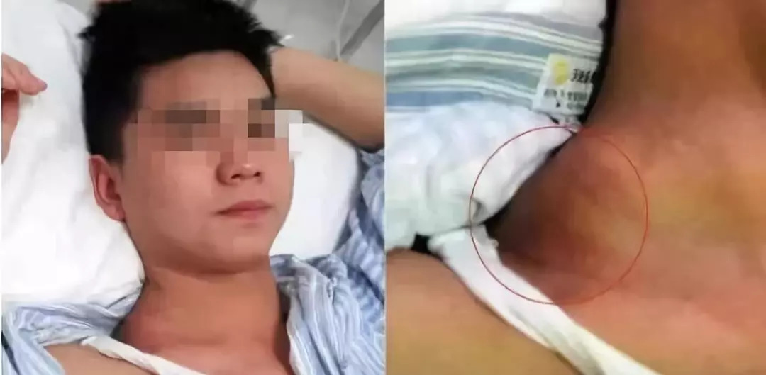 20岁小伙被诊断癌症,小伙25岁查出肝癌