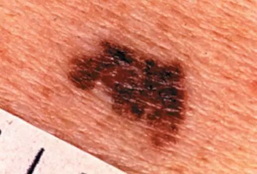 宝宝从小脚上就长黑痣是怎么回事,小孩脚后跟长了颗黑痣越来越大