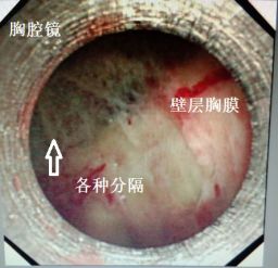 胸水为什么会抽不到,胸水抽了为什么还呼吸困难