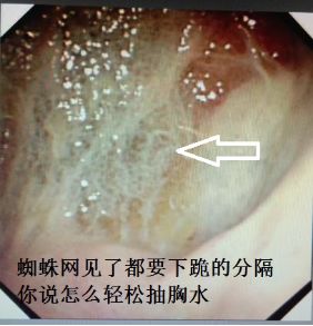 胸水抽了为什么还呼吸困难,胸水抽不出来了怎么回事