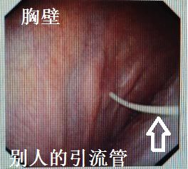 胸水为什么会抽不到,胸水抽了为什么还呼吸困难