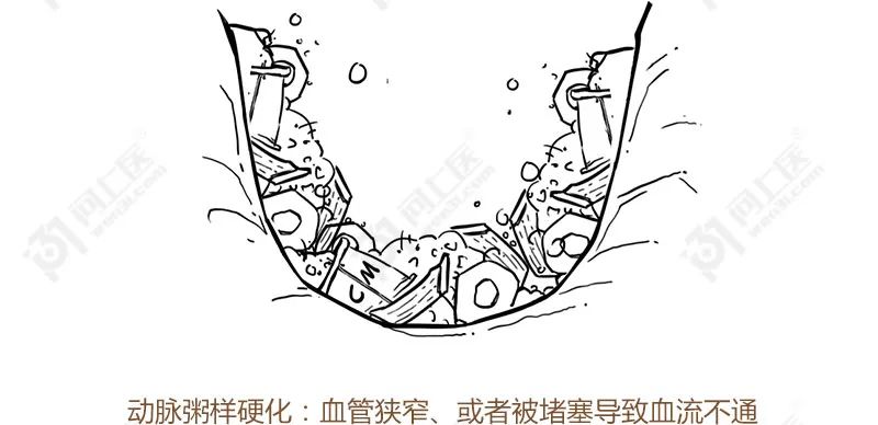 甘油三酯升高的原因动画,医学科普甘油三酯