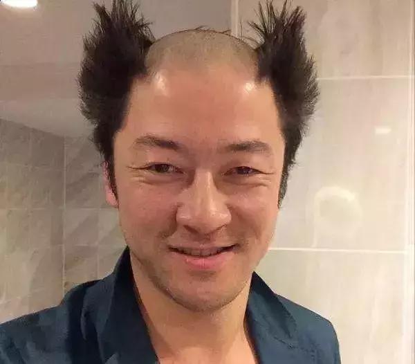 发际线高脱发用什么洗发水,发际线高掉头发洗发水测评