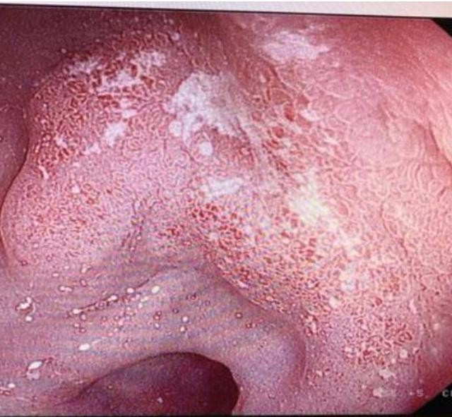 胃溃疡介绍视频,胃溃疡解析图