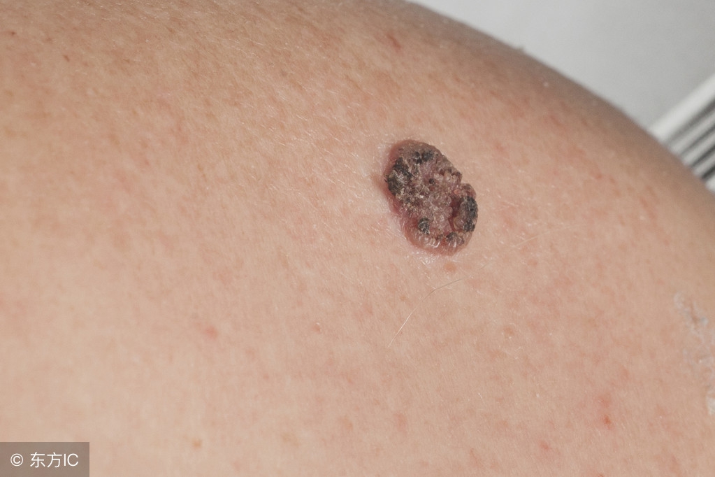 哪些皮肤病是皮肤癌的前兆呢,哪些皮肤病是癌症的前兆