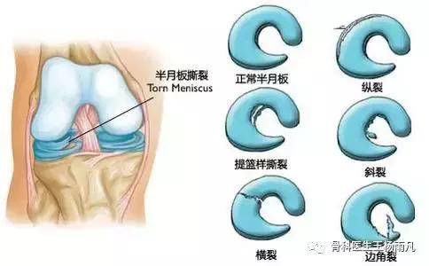 最新的人工膝关节使用寿命,膝关节使用说明